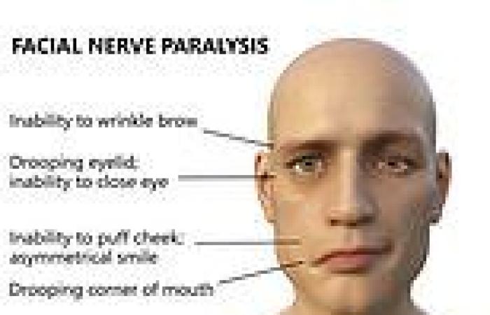 Patients with COVID-19 are SEVEN TIMES more likely to have Bell's palsy than ...