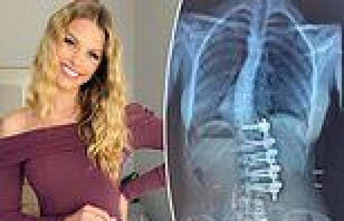 Natalie Roser shares X-ray of 'bits and pieces' holding her spine ...