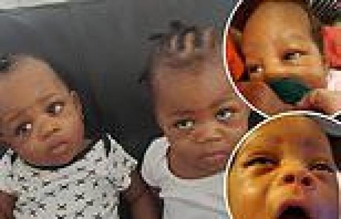 Twin babies undergo eye surgery to save their vision after their mother noticed ...