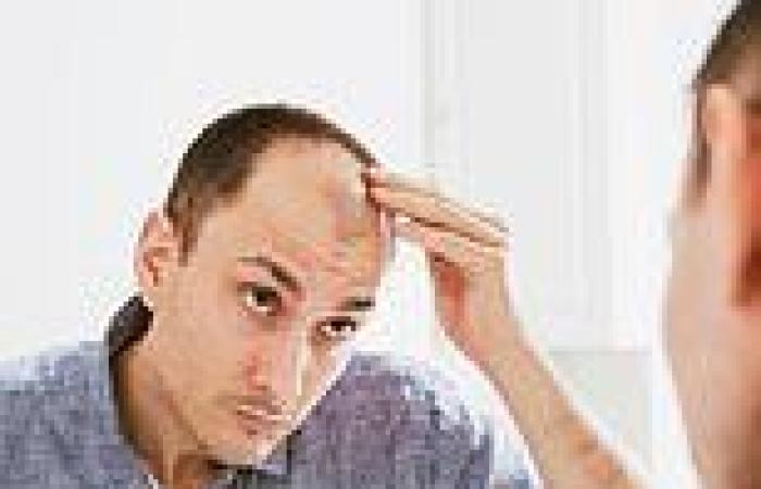 Men with hair loss should be offered therapy to cope with the trauma, experts ...