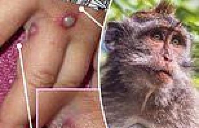 Texas man hospitalized with monkeypox after being infected with illness during ...