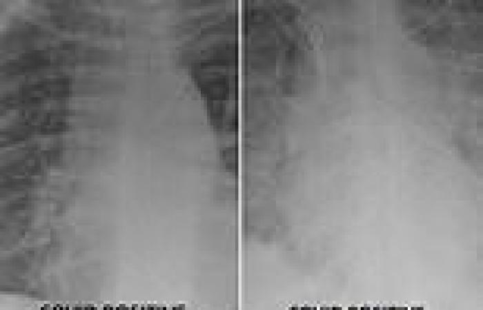 Doctor shares X-rays showing difference in lungs of unvaccinated and vaccinated ...