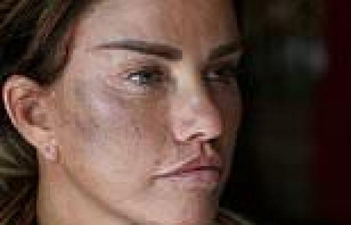 Katie Price is seen with large bruise on her face after 'unprovoked 1.30am ...