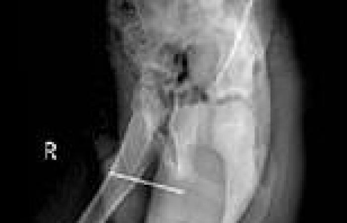 Boy who shoved a sewing needle into his penis gets it removed through the skin ...