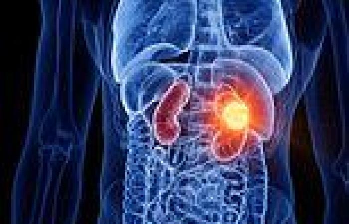 Study shows patients with incurable kidney cancer can take 'treatment holidays' ...
