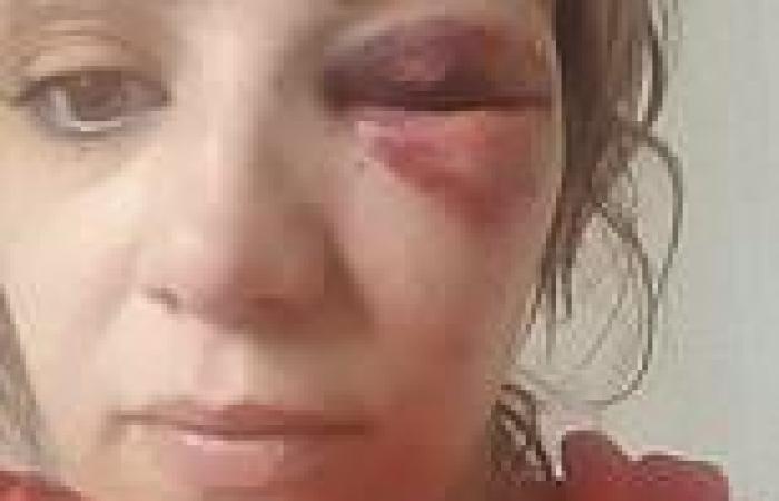 Mother reveals 'life in hell' with ex who left her with permanent injuries when ...