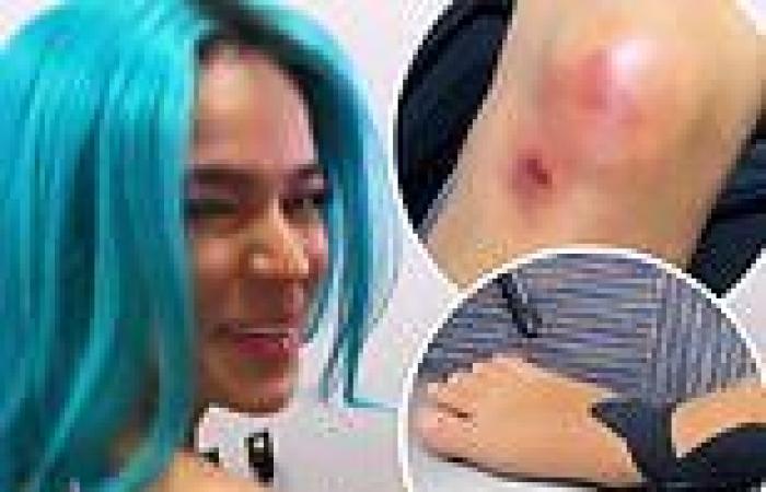 Karol G shows off injuries including bandaged ankle after tumbling down stairs ...
