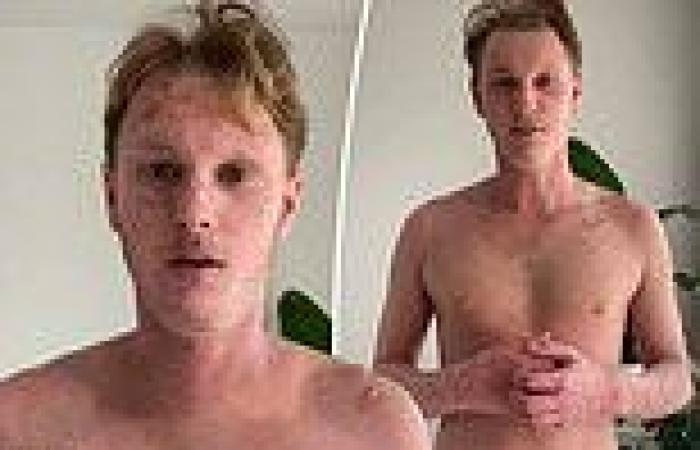 Young man battling a rare skin condition shows his amazing recovery using 'no ...