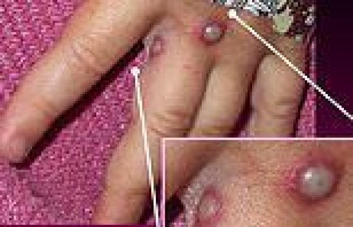 Wednesday 18 May 2022 05:04 AM Australian health authorities on high alert over deadly 'monkeypox' virus trends now