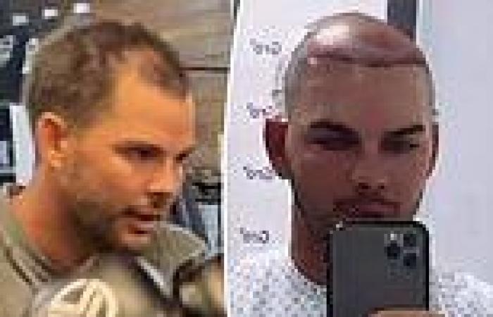 Wednesday 6 July 2022 06:51 AM Bachelor in Paradise star Matt Whyatt undergoes drastic hair transplant as he ... trends now