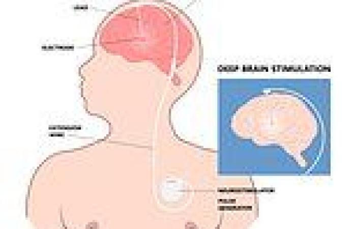 Tuesday 20 September 2022 11:41 PM Brain 'pacemakers' could help patients with OCD trends now