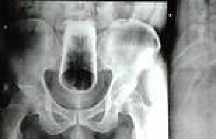 Married man, 47, got glass stuck in his bum for three days while drunk trends now