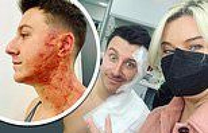 Coronation Street behind-the-scenes snaps show Ryan's gruesome injuries after ... trends now