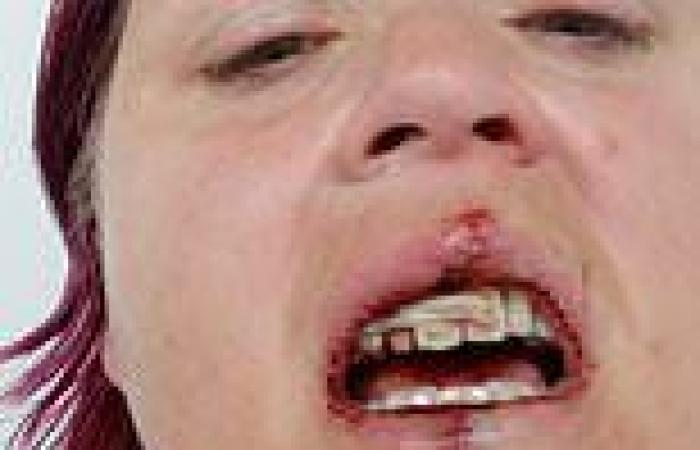 Mother reveals shocking injuries to face and teeth after partner who smashed ... trends now