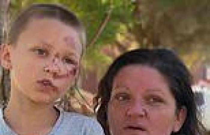Autistic boy's face cut and bruised after being 'bullied' at Villawood East ... trends now