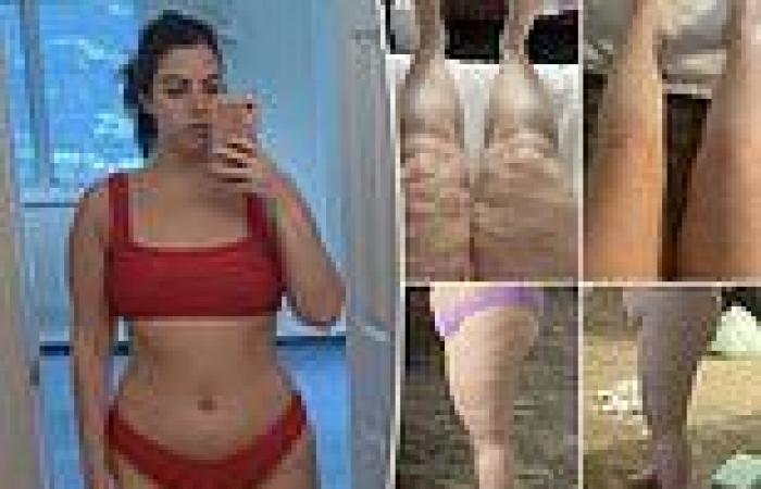 Curvy woman diagnosed with fluid-retention condition has nearly 2 GALLONS of ... trends now