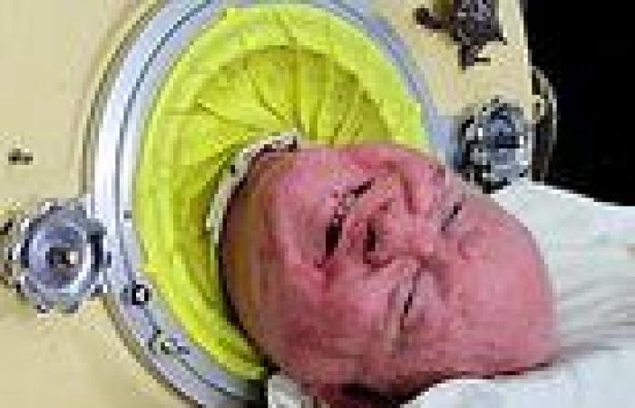 Iron lung man Paul Alexander dead at 78: Lawyer who was paralysed after ... trends now