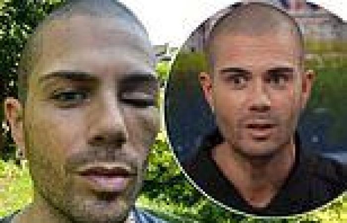 Max George leaves fans concerned after revealing painful bruised and swollen eye trends now