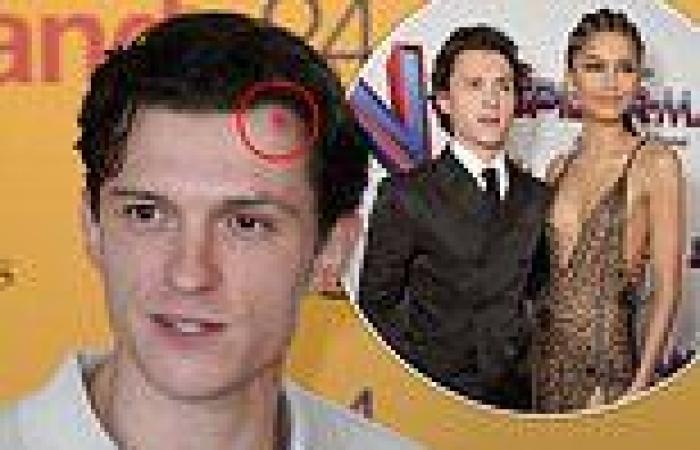Tom Holland sports a bruise after 'being hit on the head with a golf ball' ... trends now