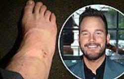 Chris Pratt reveals he injured his ankle on just the fourth day of filming his ... trends now