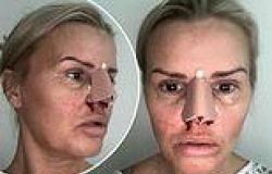 Kerry Katona reveals the gruesome results of her nose job after going under the ... trends now
