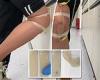 Hong Kong researchers create artificial skin that mimics bruising by turning ...