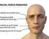 Patients with COVID-19 are SEVEN TIMES more likely to have Bell's palsy than ...