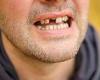 People who start losing their teeth are more likely to develop DEMENTIA