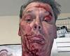 Man, 55, reveals horrific injuries at the hands of 'controlling' ex who was ...