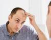 Men with hair loss should be offered therapy to cope with the trauma, experts ...