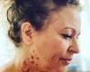 Nadia Sawalha reveals awful neck burns after being scalded by boiling honey in ...