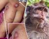 Texas man hospitalized with monkeypox after being infected with illness during ...