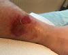 Stockport dog walker shares burn pictures after he brushed past a toxic Giant ...