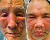 Two men developed PUS-FILLED bumps on their faces in rare side effect from ...