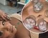 Lizzo flashes the flesh on Instagram as she gets facial acupuncture and cupping ...