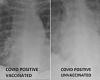 Doctor shares X-rays showing difference in lungs of unvaccinated and vaccinated ...