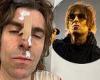 Liam Gallagher suffers a nasty facial injury after falling out of a helicopter ...