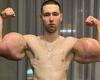 Russian 'Bazooka' bodybuilder warned he could die unless he has huge fake bicep ...