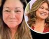 Valerie Bertinelli shows off the red spots on her face after second painful ...