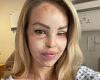 Katie Piper reveals she was hospitalised for emergency surgery after choking on ...