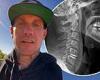 Pink's husband Carey Hart posts X-rays after successful neck surgery to replace ...