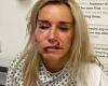 Mother-of-two, 45, scarred for life after attack by a masked gang who tried to ...