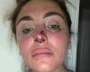 Mother-of-two shares images of her injuries after partner BIT her nose and face ...