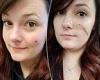 Young woman devastated as 'cute' heart-shaped freckle diagnosed as 'aggressive' ...