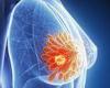 How cutting doses of cancer therapy can reduce side-effects... but be just as ...