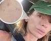 Makeup free Nadia Bartel reveals she has acne and shows off the 'sore skin ...