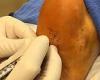 Debilitating foot pain 'could be treated by using fat injections'