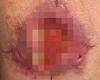 Skin disease detected in Melbourne's northern suburbs - buruli ulcer