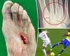 sport news Cadiz's Carlos Akapo posts GRUESOME pictures of his broken foot following Eden ... trends now