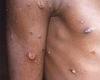 Thursday 2 June 2022 06:25 AM Monkeypox outbreak spreads as NEW case is identified in Australia trends now
